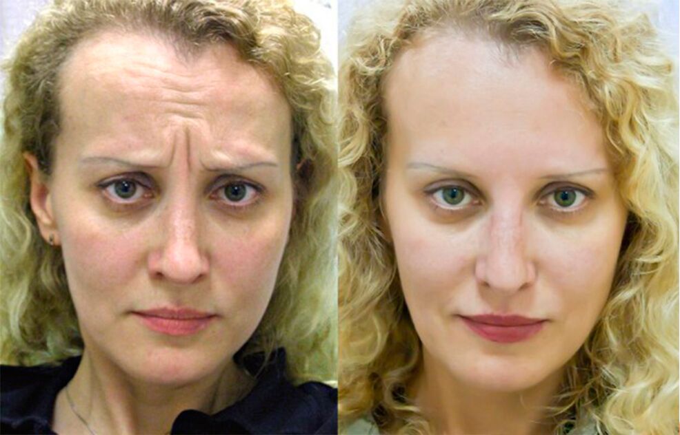 gençleştirme için masaj aletini kullanmadan önce ve sonra ltza photo 1