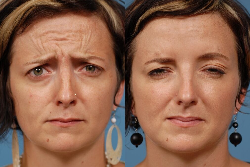 gençleştirme için masaj aletini kullanmadan önce ve sonra ltza photo 2