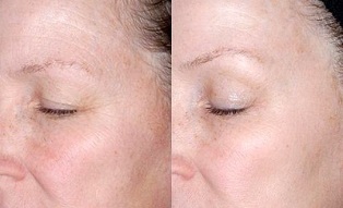fotoğraflardan önce ve sonra göz çevresindeki cildin gençleşmesi